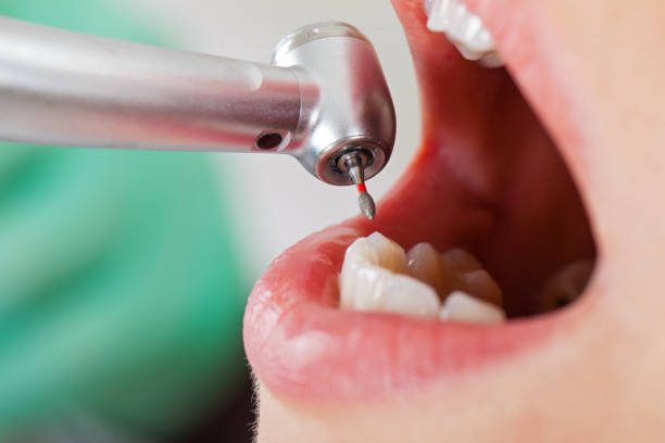 Best Emergency Tooth Extraction in North Ridgeville, OH
